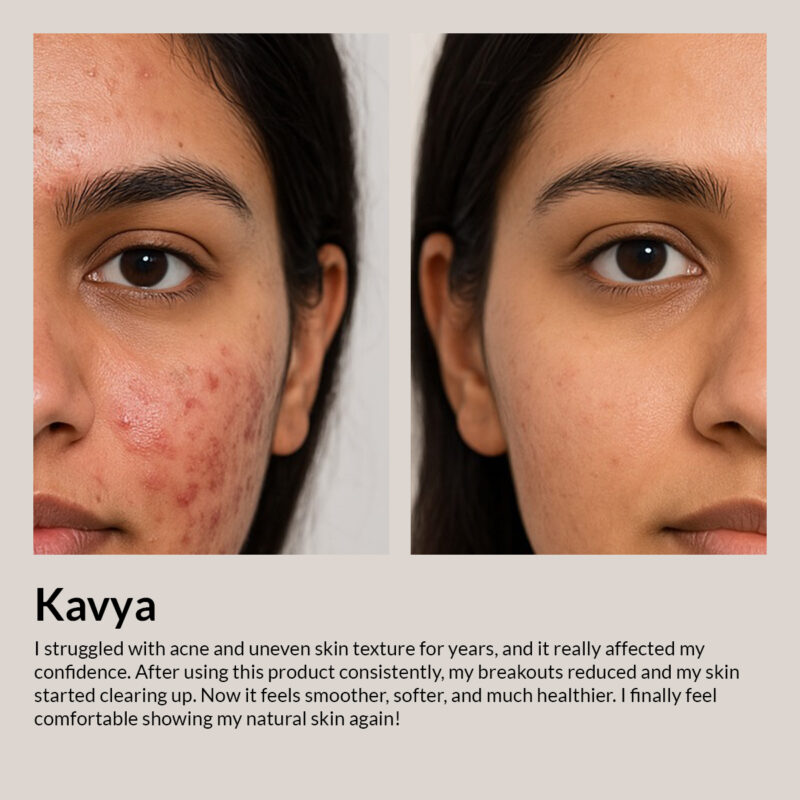 Camel Milk Anti-Acne Night Cream with Salicyclic acid + Niacinamide 4% - Image 5